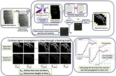Automatic Estimation of Coronary Blood Flow Velocity <mark class="highlighted">Step 1</mark> for Developing a Tool to Diagnose Patients With Micro-Vascular Angina Pectoris